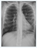 A Rare Case of Brain Metastasis