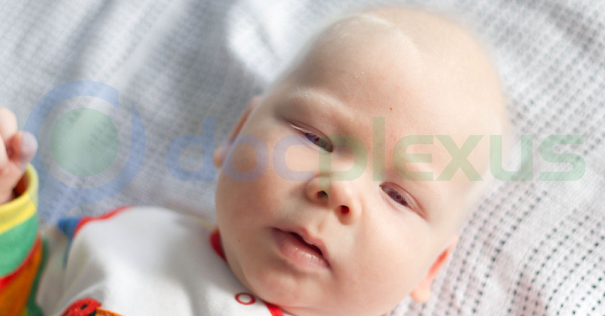Albinism, A Brief Review