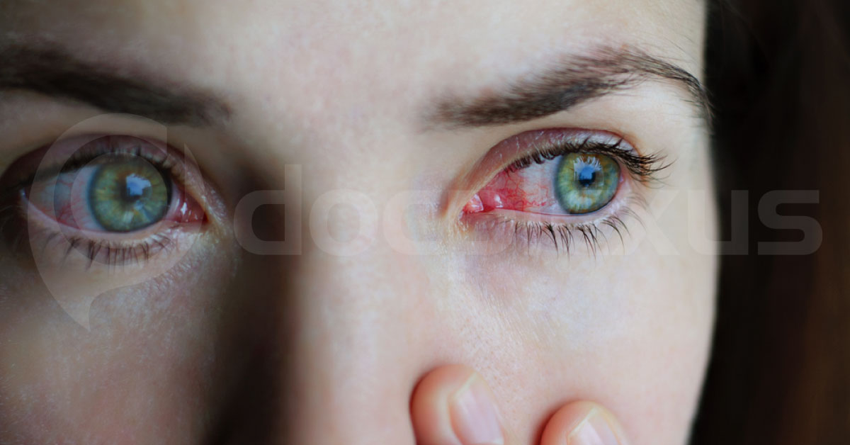 Brief Review On How To Proceed With Treatment Of V K Conjunctivitis