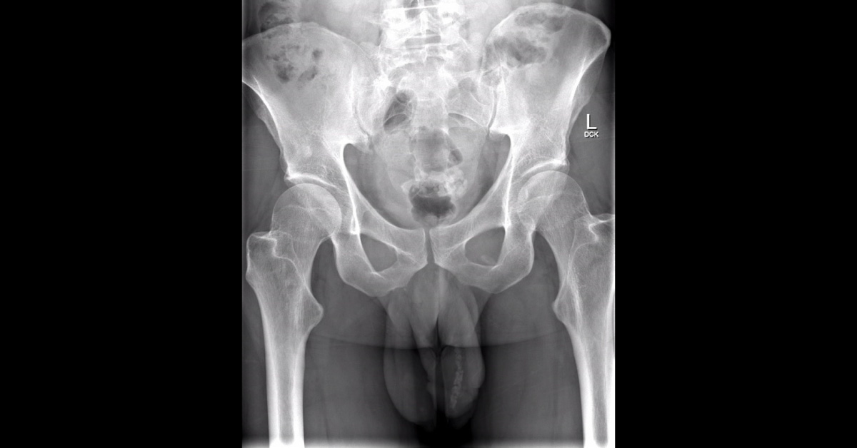 Male with Urinary Retention and Dysuria
