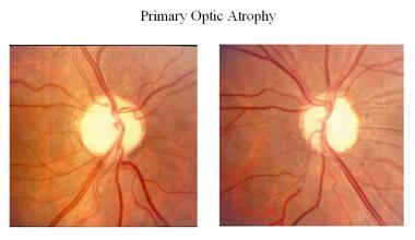 Brief Review On Medical Treatment Of Glaucoma Past And Present