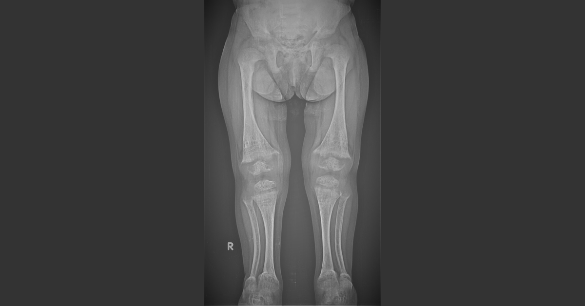 Child with Bowing of Lower Limbs