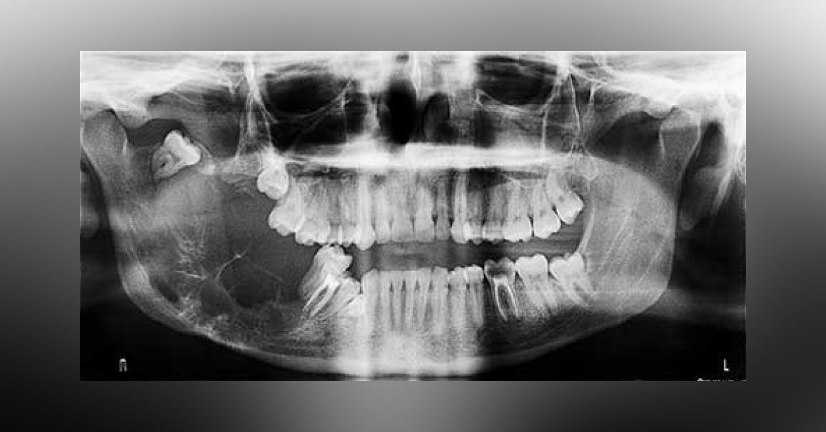 Case of Right Mandibular Swelling