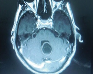 Hydatid Cyst In Cerebellum: A Rare Case Report