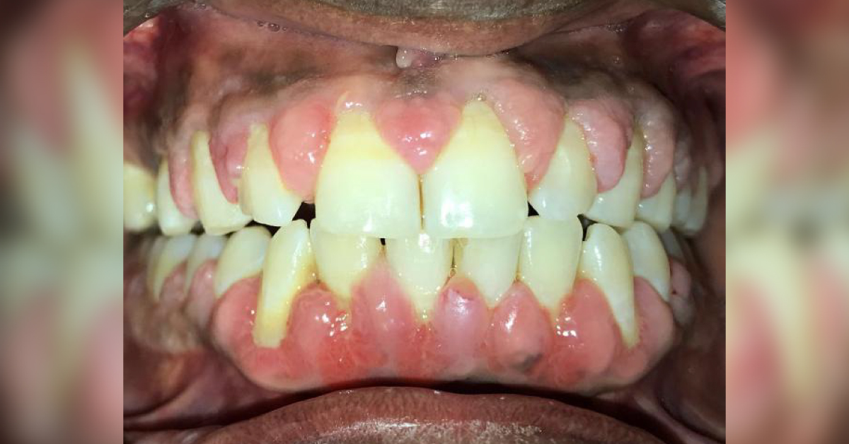 Treatment For Generalized Gingival Enlargement