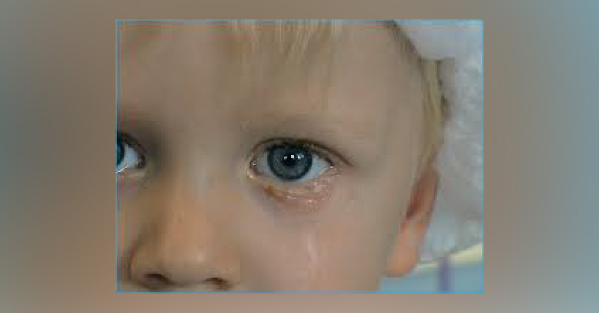Brief Review Of Congenital Tear Duct Obstruction