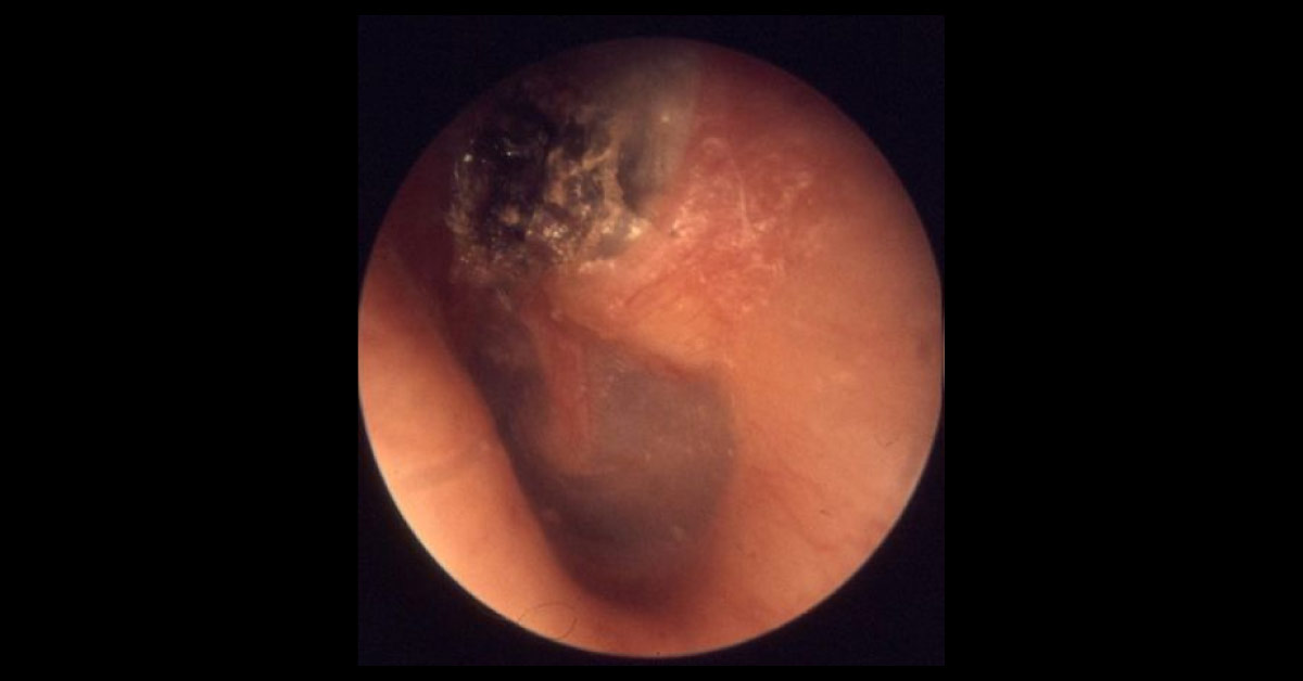 Case of Recurrent Ear Discharge