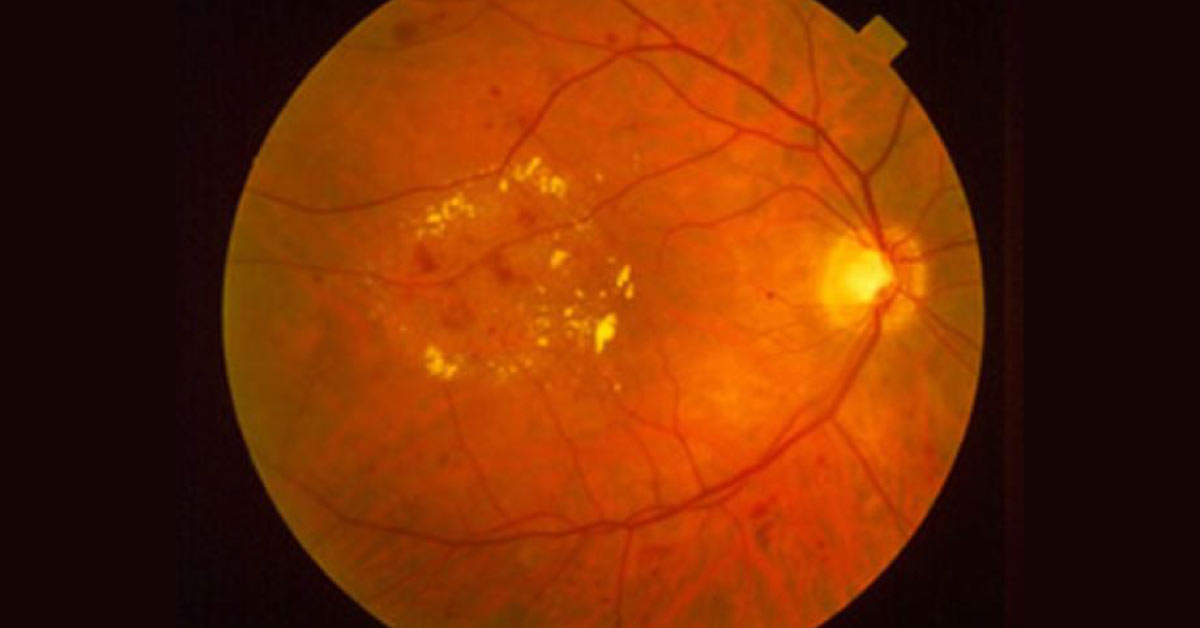 Brief Review On Uses Of Anti V G Drugs In Diabetic Macular Odema