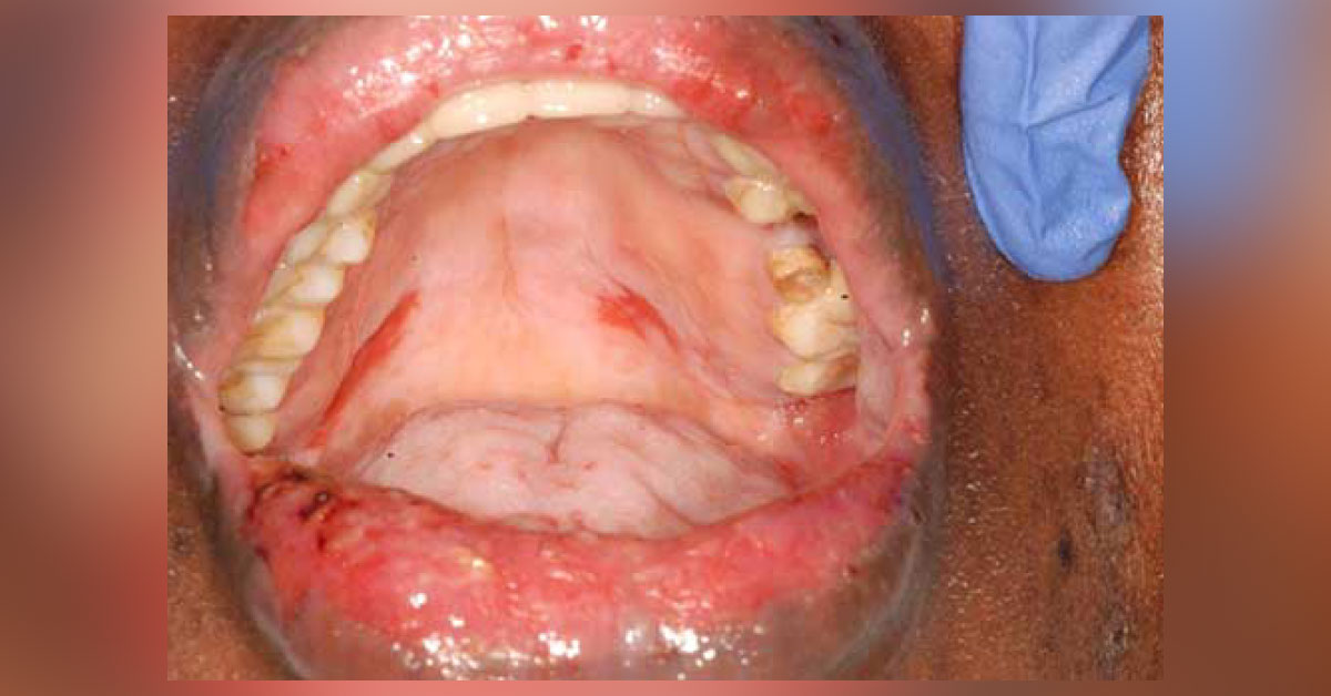 Generalized Oral Ulcers In A Female