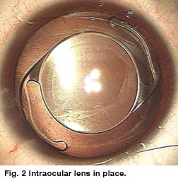 Brief Review On Aproach Of Intraocular Surgery