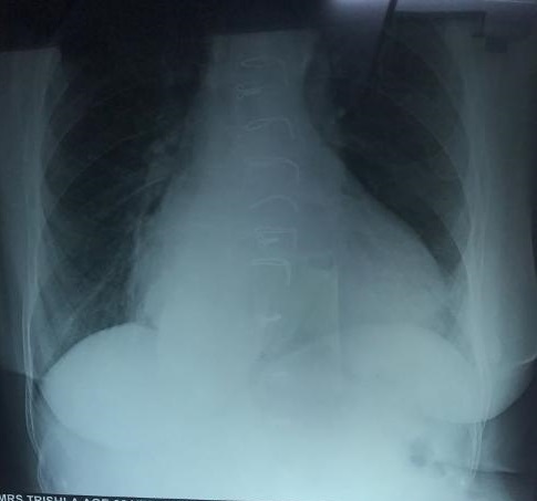 Is This An Aortic Dissection Shadow?