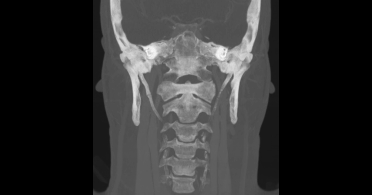 Sensation of a Foreign Body in Throat