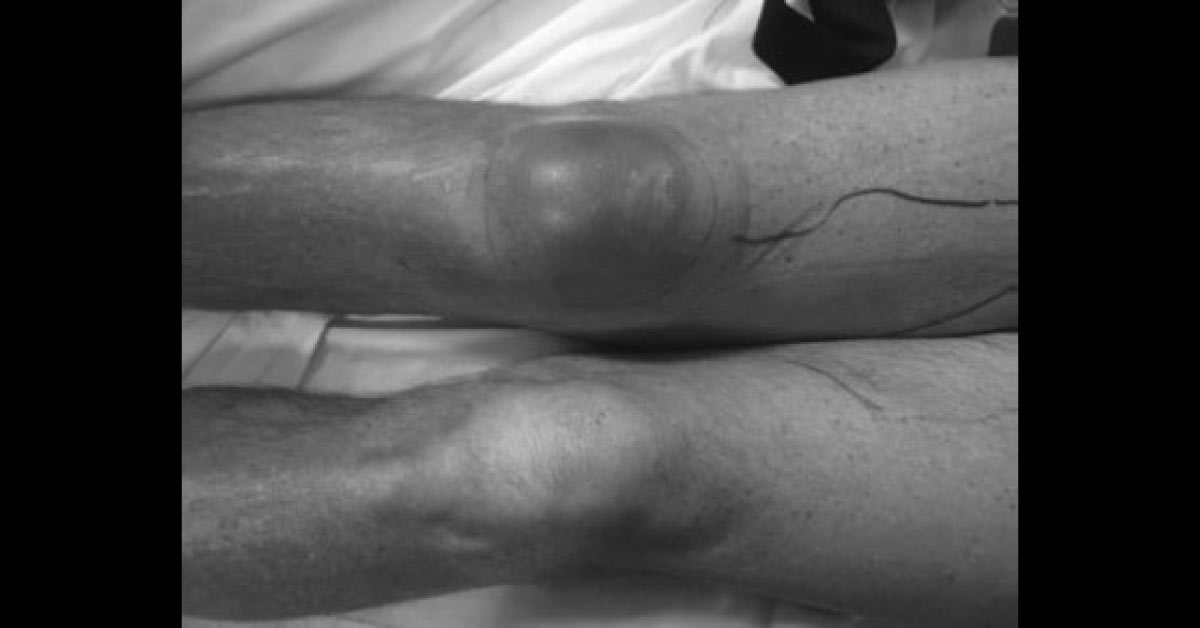A Case Of Painful Red Swelling