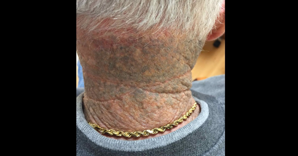 Which Drug Caused This Condition?