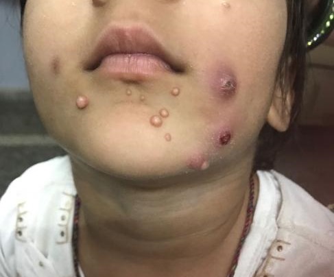 What Are These Skin Leasion