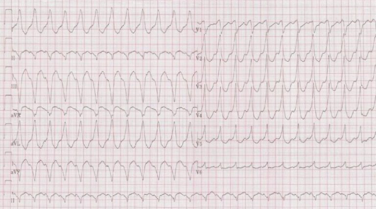 What Abnormality Do You Observe In This ECG