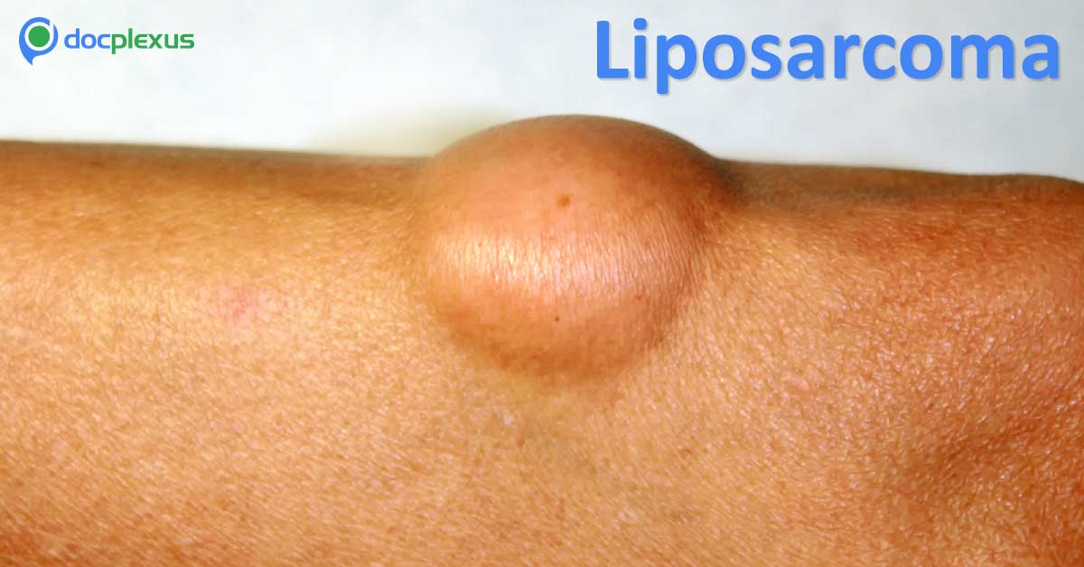 Patient With Liposarcoma