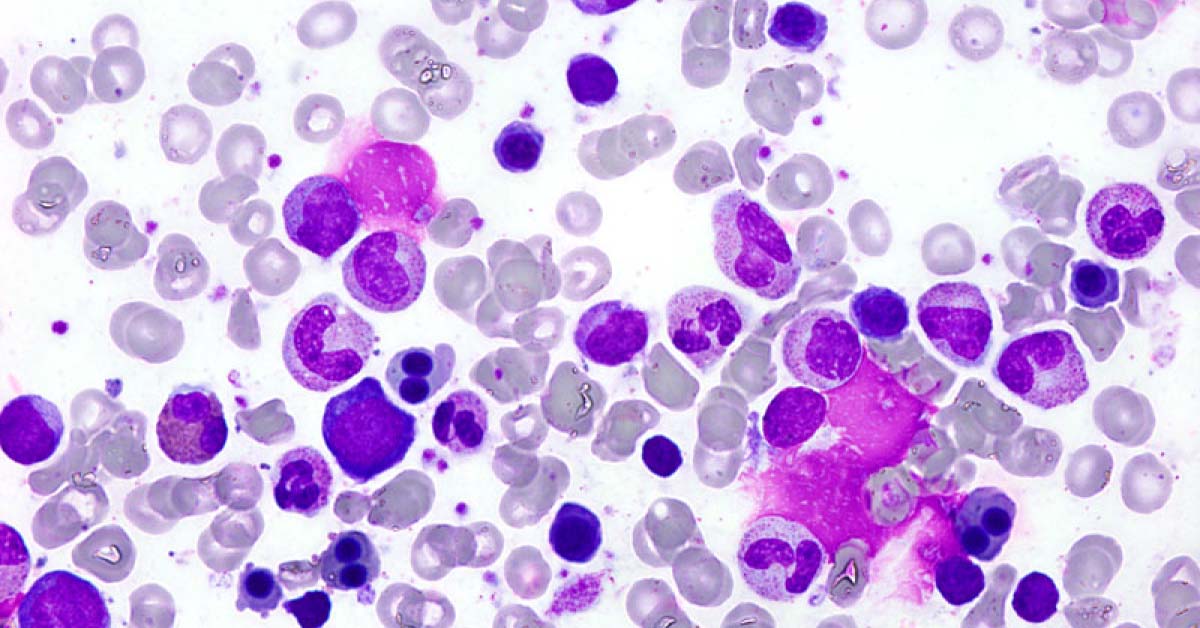 Pre-term Infant with Persistent Anemia