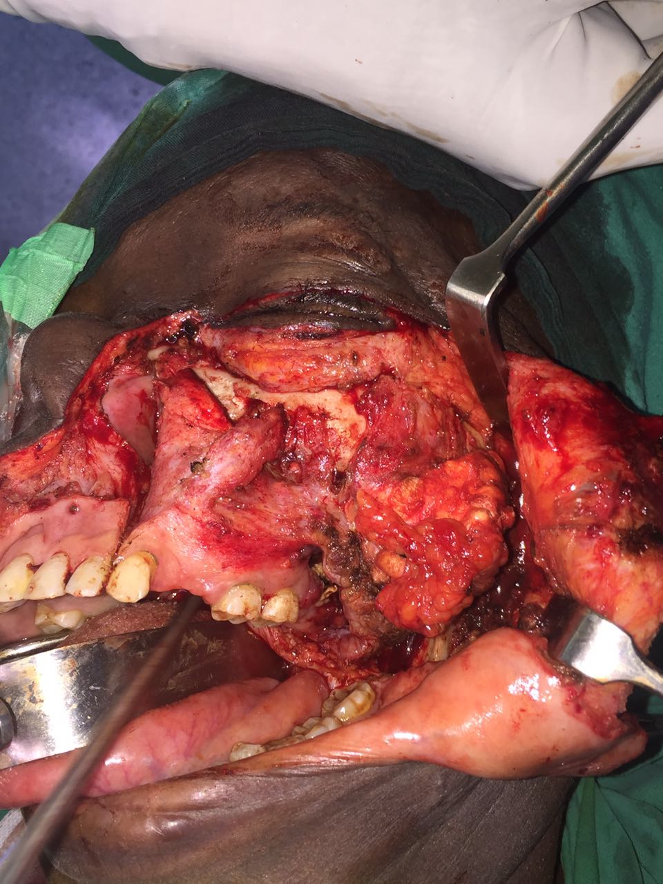 Osteosarcoma Of Maxilla