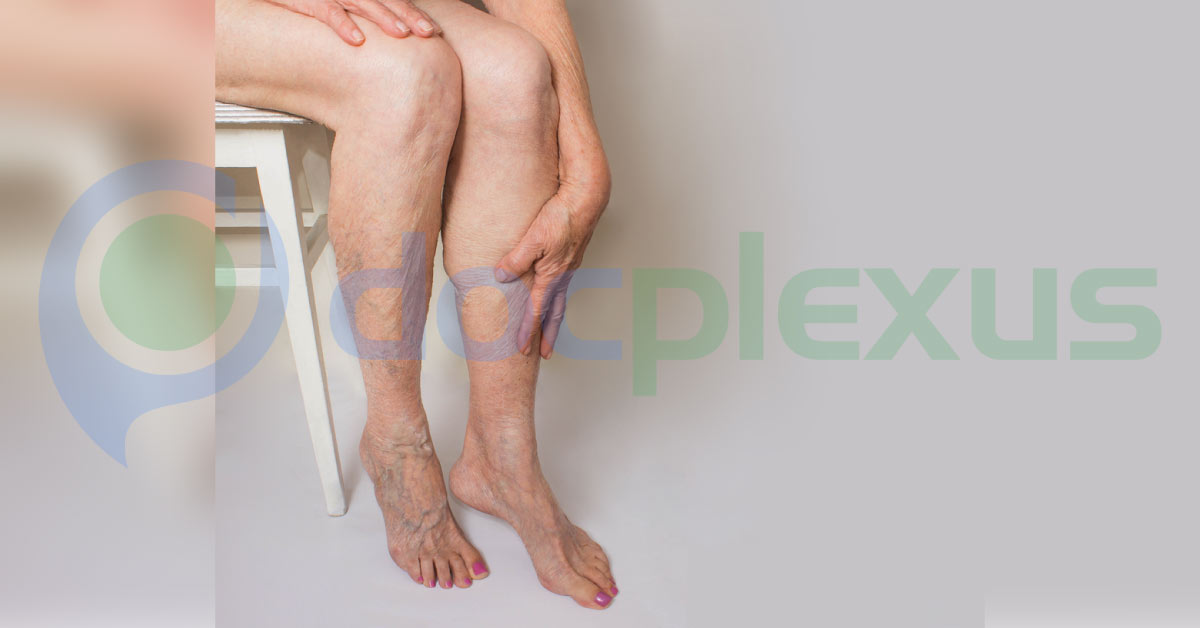 Varicose Viens May Increase Risk Of Blood Clots And Pulmonary Embolism