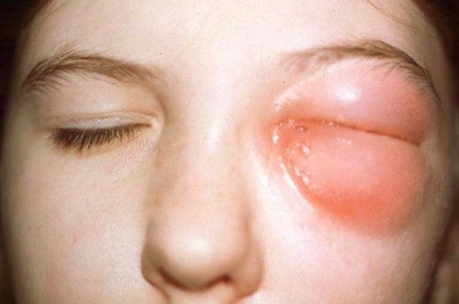 Brief Review On Orbital Cellulitis