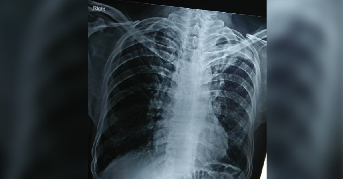 What Is In Left Upper Lobe? What Does The X-ray Chest Shows?