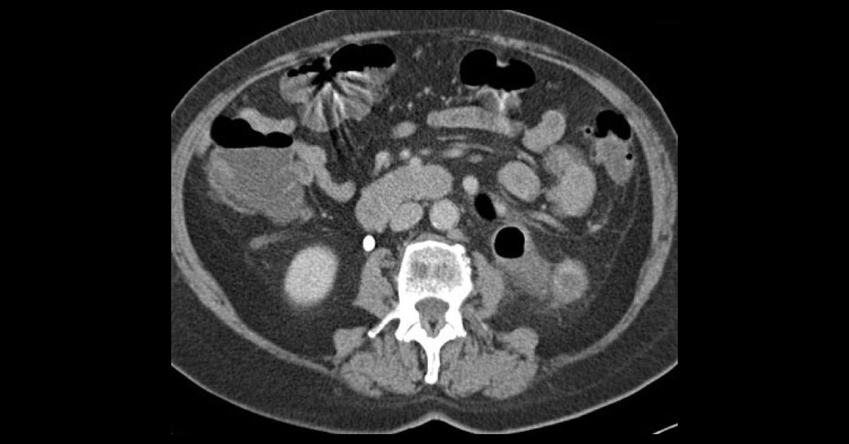 Spot the urologic abnormality?