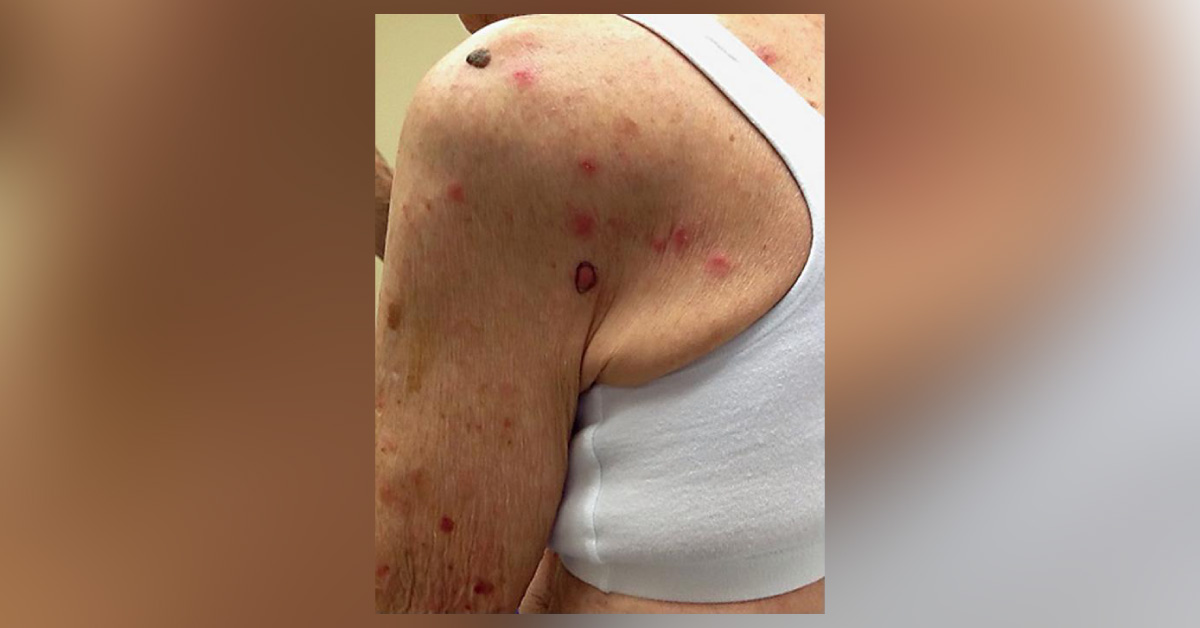 A Woman with Itchy Rashes