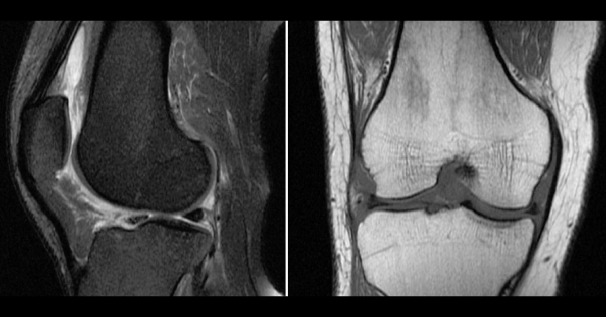 Identify the Cause of Sudden Knee Pain in This Man