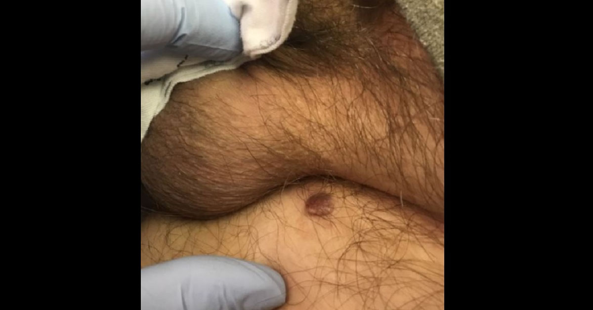Dome Shaped Growth On Thigh