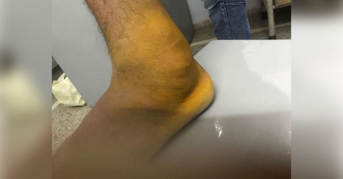 What Is This Cystic Swelling Over Ankle? 