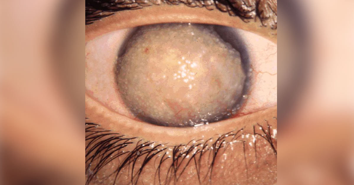 Rare Congenital Associations With Bil Cong Corneal Dystrophy