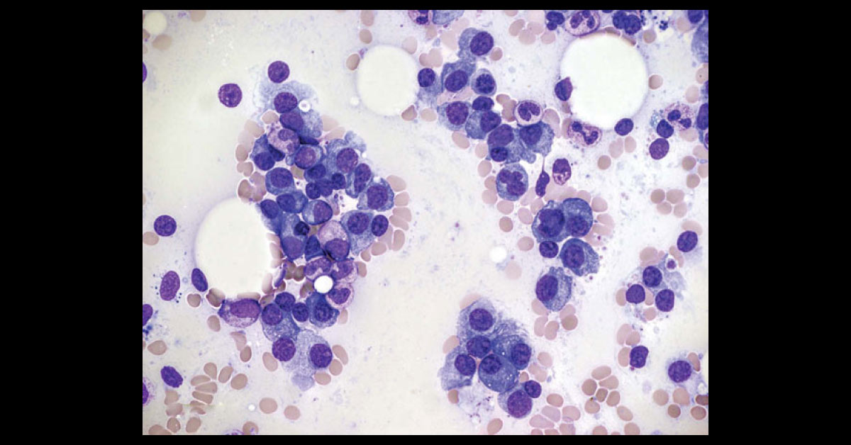 Interpret The Bone Marrow Aspirate