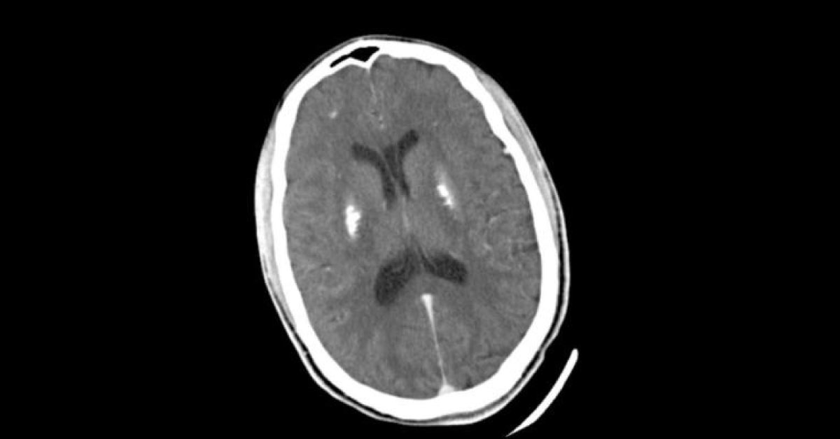 A Young Man With Recurrent Seizures