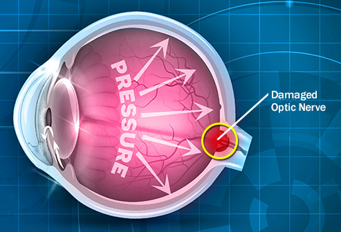 Understanding Classification Of Glaucoma