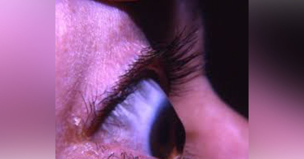 Rare Associations With Keratoconus