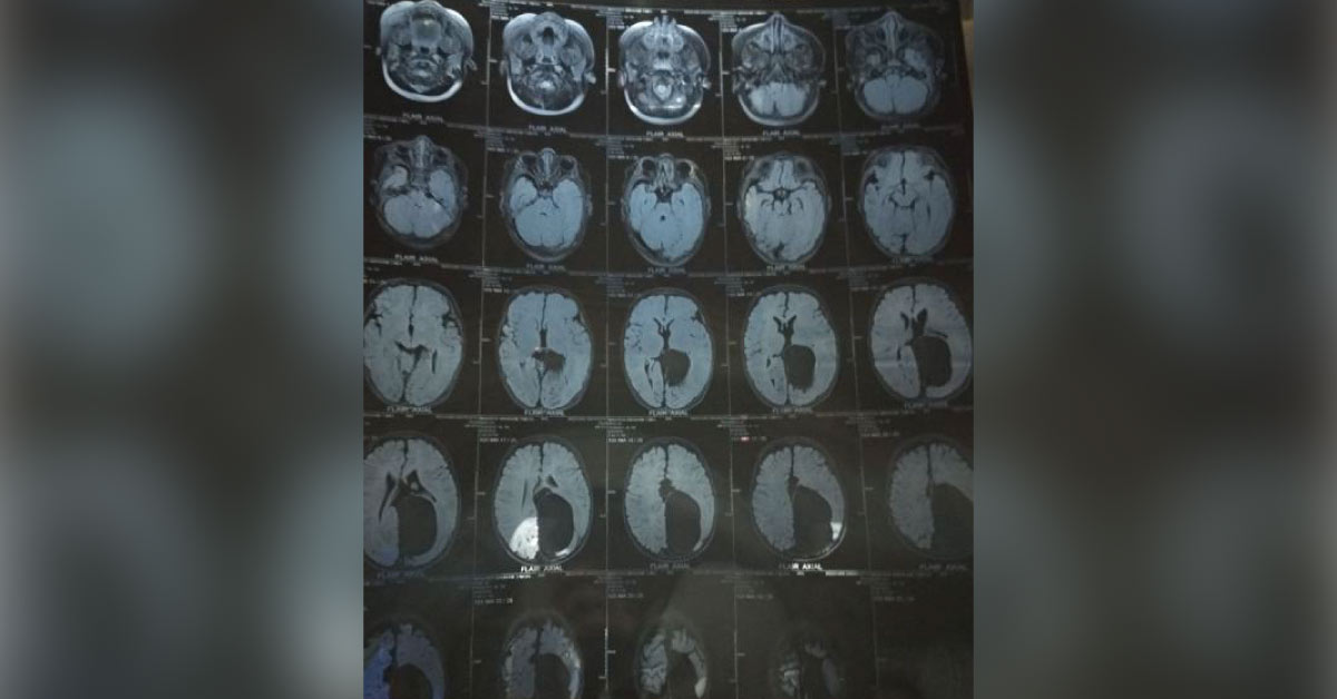 Hearing Loss In A 6 Months Infant With Large Interhemispheric Extra Axial Brain Cyst