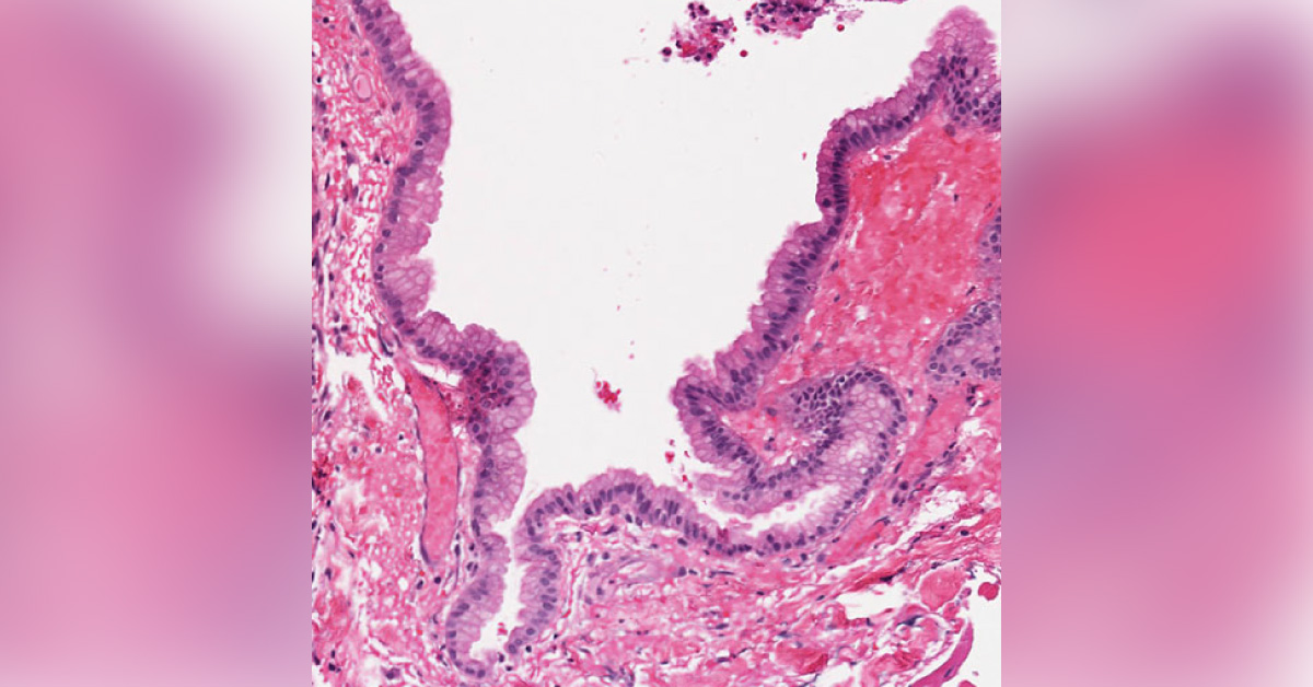 Preadolescent Female With Neurological Symptoms