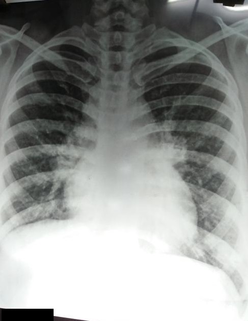 What Is The Cause Of Cough?
