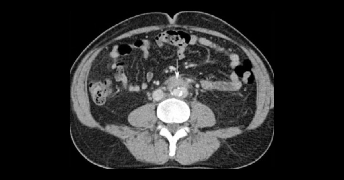 An Elderly Man with Lower Back Pain and Chills