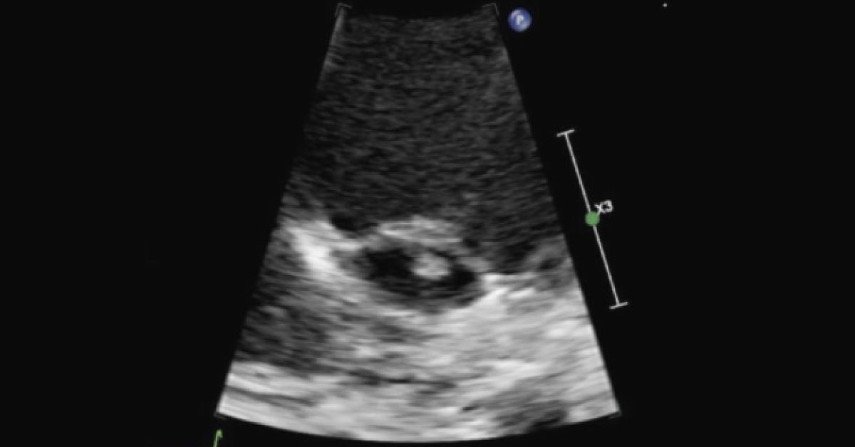 Case of a Boy with Fever of Unknown Origin