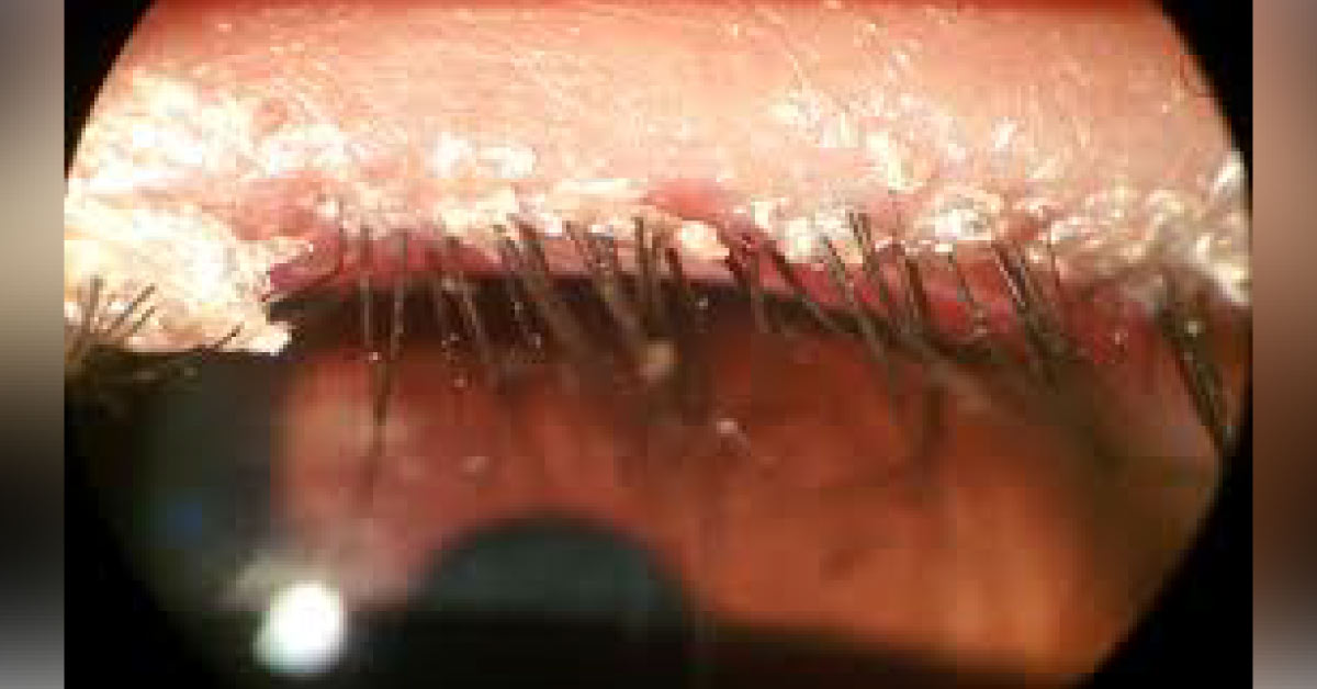 Brief Review On Blepharitis