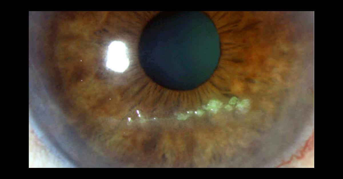 Brief Review On Ocular Complications Of Herpes Zoster Ophthalmics