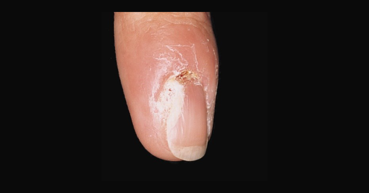 Case of a Female with Painful Erosions