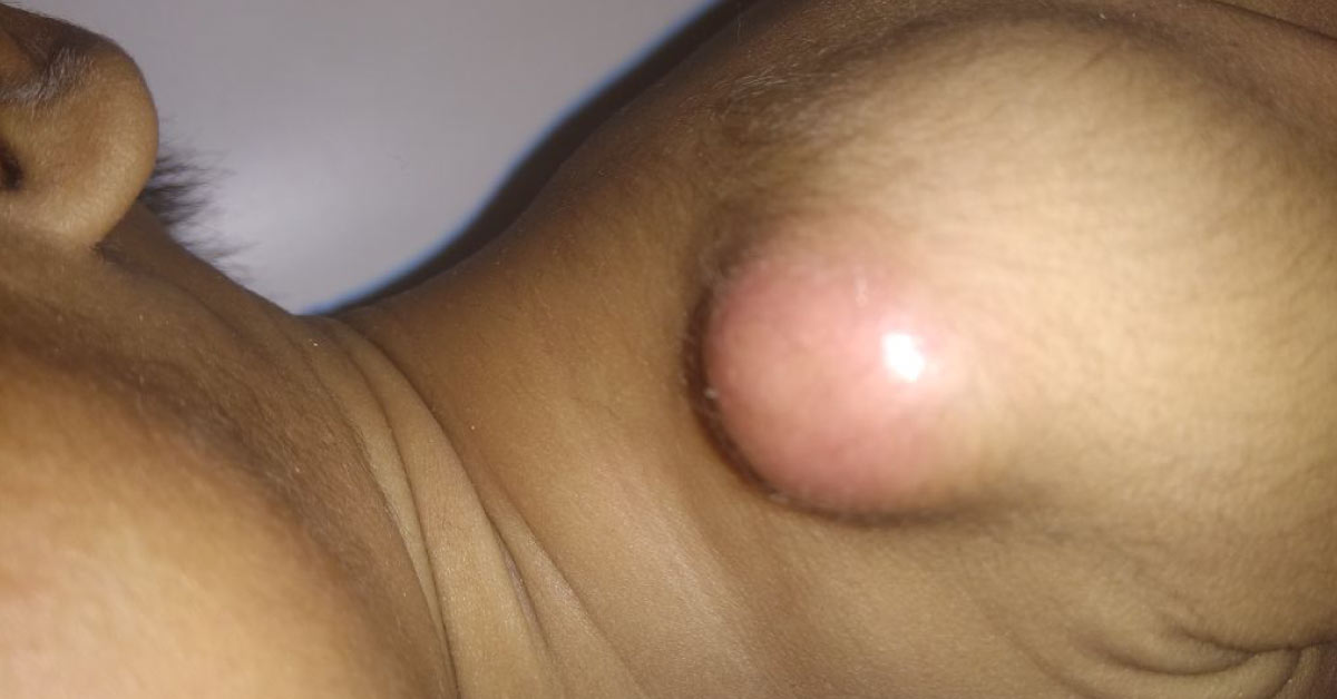 Management Of Abscess At BCG Vaccination Site