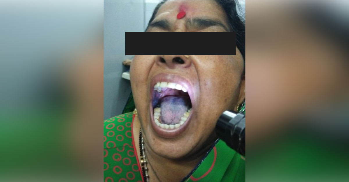 Black Discolouration Of Toungue And Buccal Mucosa, Cause? 