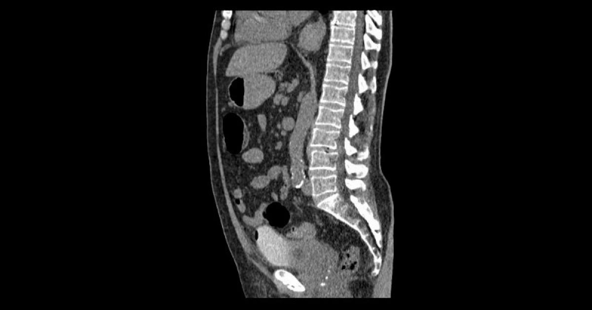 An Old Man With Recurrent Urinary Tract Infections