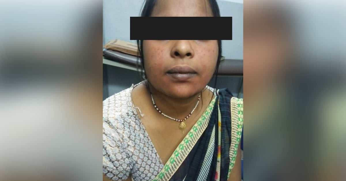 What Is The Cause Of Gradually Becoming Red Face? 