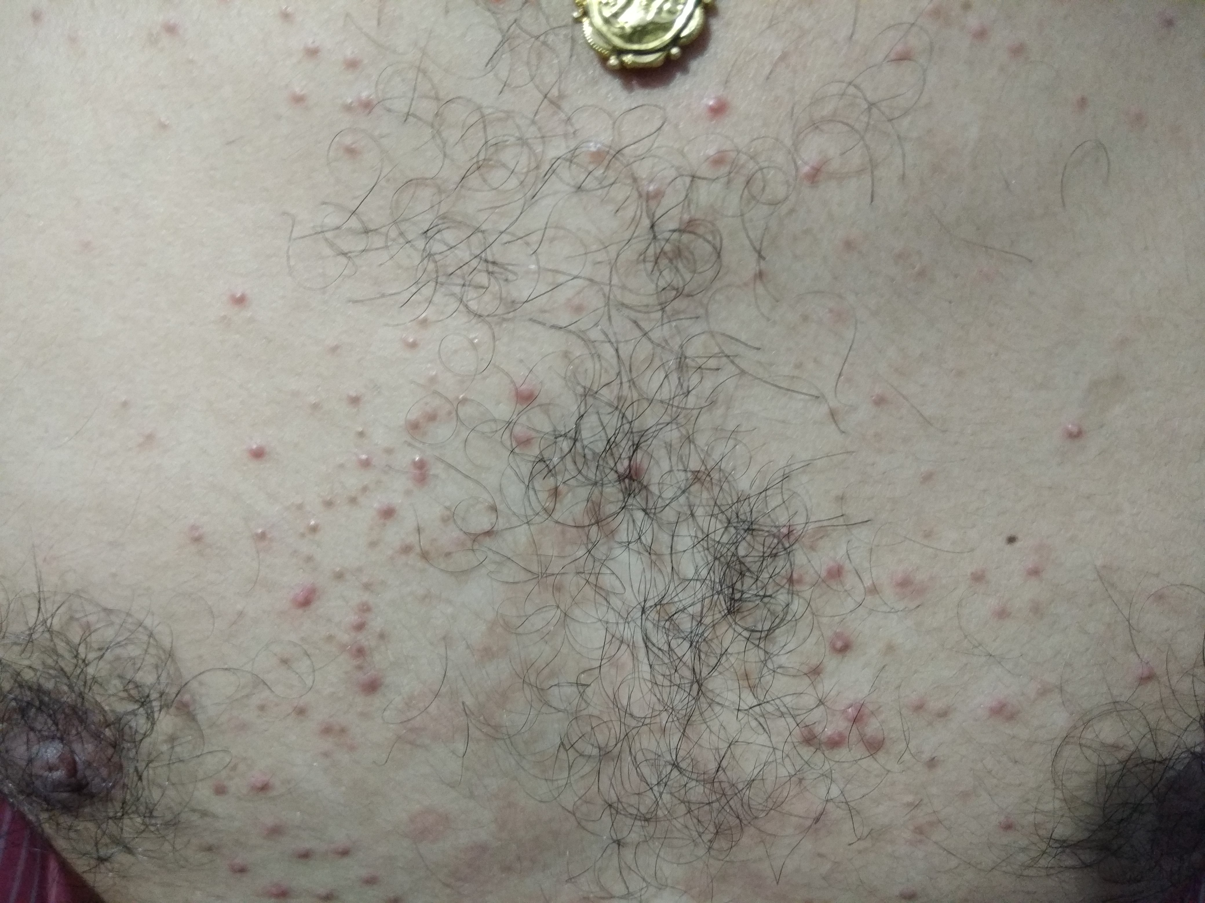 Suggest Treatment For Tinea Corporis