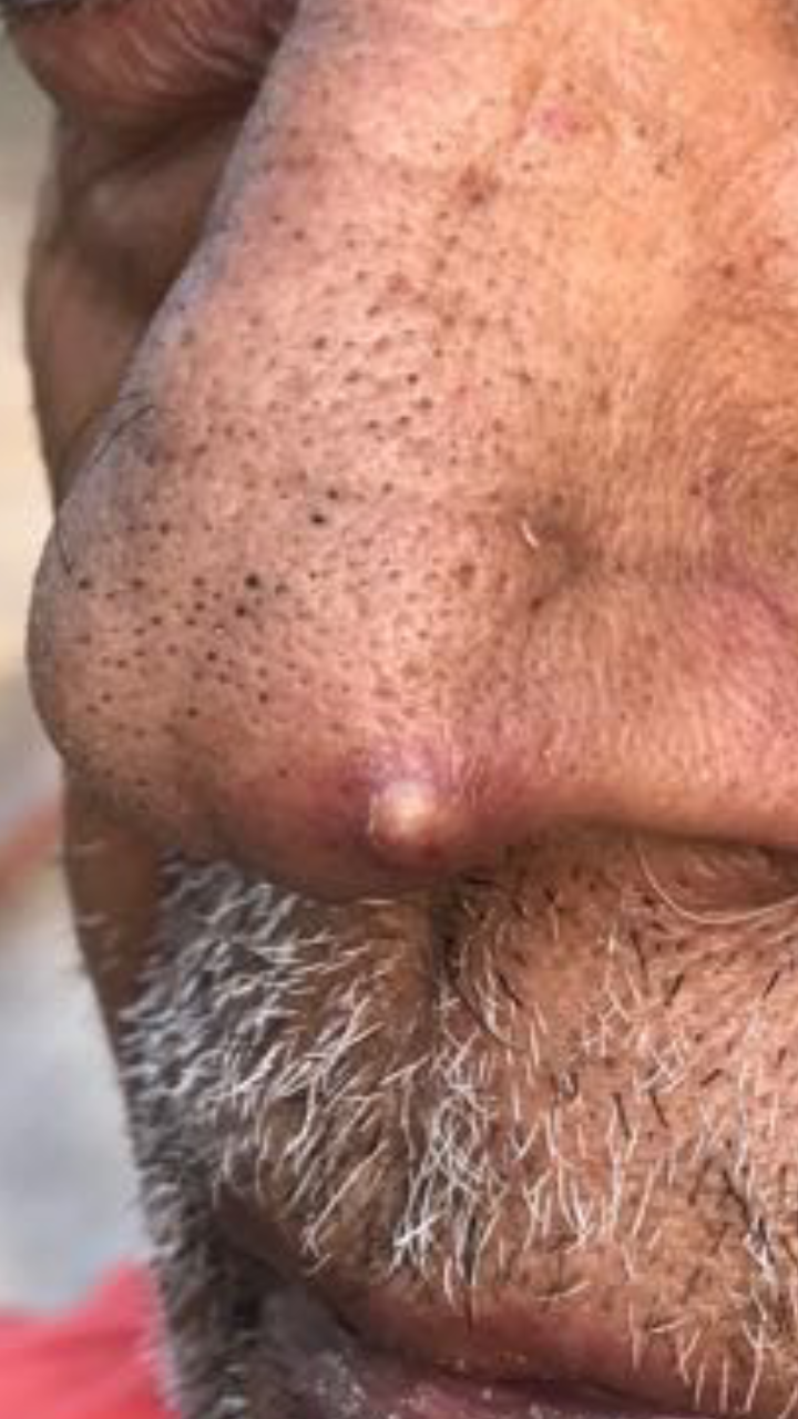 Identity This Lesion On Tip Of The Nose? 